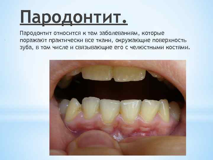Пародонтит относится к тем заболеваниям, которые поражают практически все ткани, окружающие поверхность зуба, в