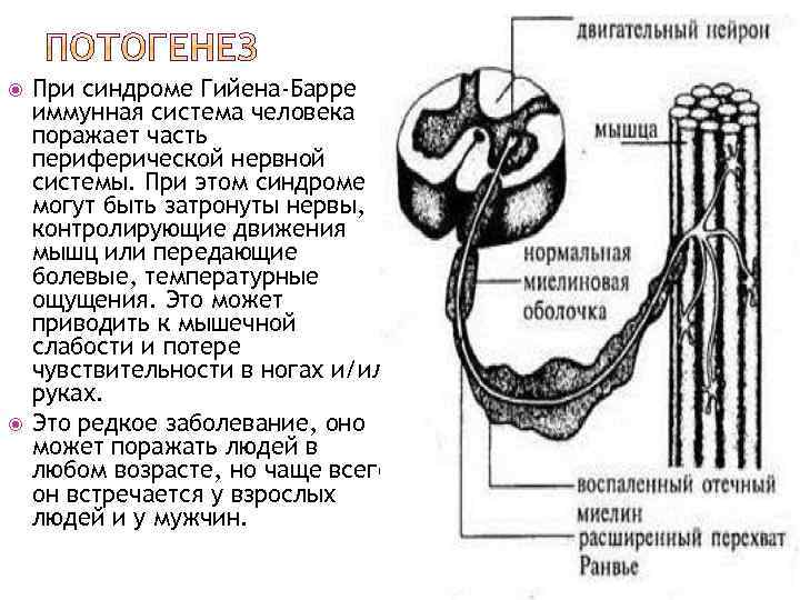  При синдроме Гийена-Барре иммунная система человека поражает часть периферической нервной системы. При этом