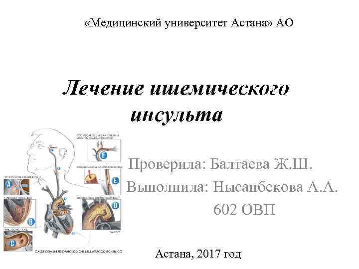  «Медицинский университет Астана» АО Лечение ишемического инсульта Проверила: Балтаева Ж. Ш. Выполнила: Нысанбекова