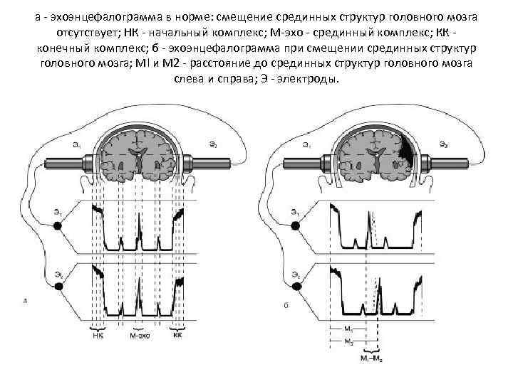 а - эхоэнцефалограмма в норме: смещение срединных структур головного мозга отсутствует; НК - начальный