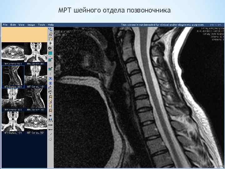 МРТ шейного отдела позвоночника 