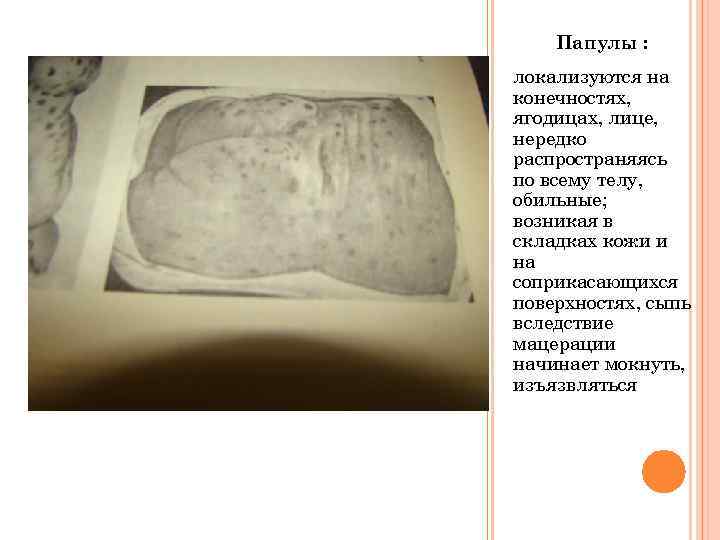 Папулы : локализуются на конечностях, ягодицах, лице, нередко распространяясь по всему телу, обильные; возникая