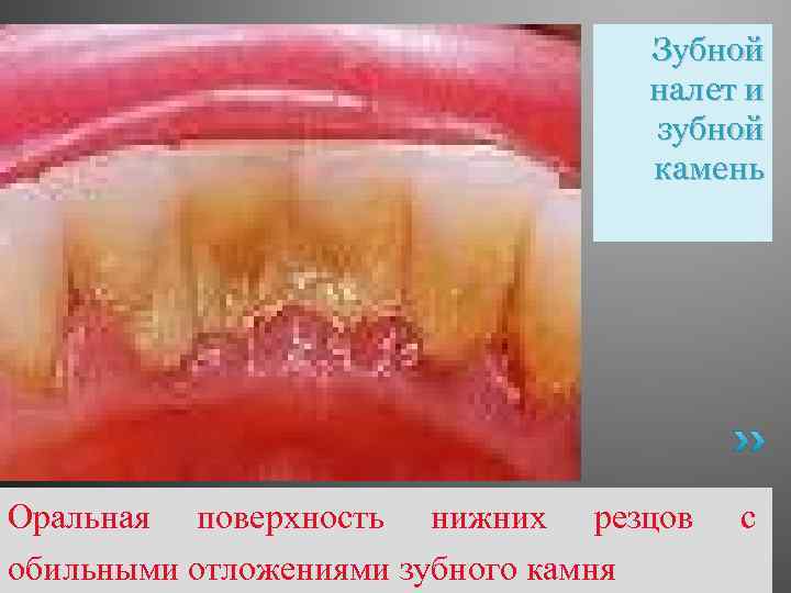 Зубной налет и зубной камень Оральная поверхность нижних резцов обильными отложениями зубного камня с