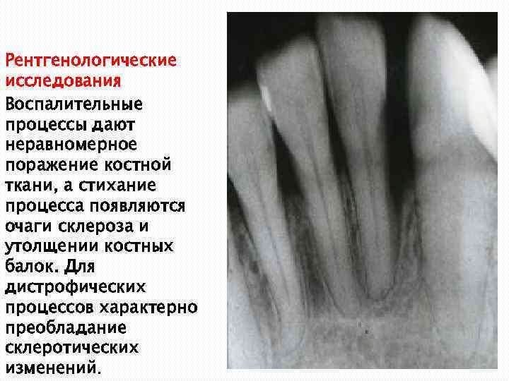 Рентгенологические исследования Воспалительные процессы дают неравномерное поражение костной ткани, а стихание процесса появляются очаги