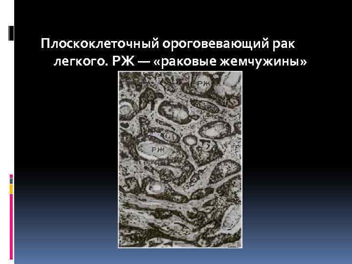 Плоскоклеточный ороговевающий рак легкого. РЖ — «раковые жемчужины» 