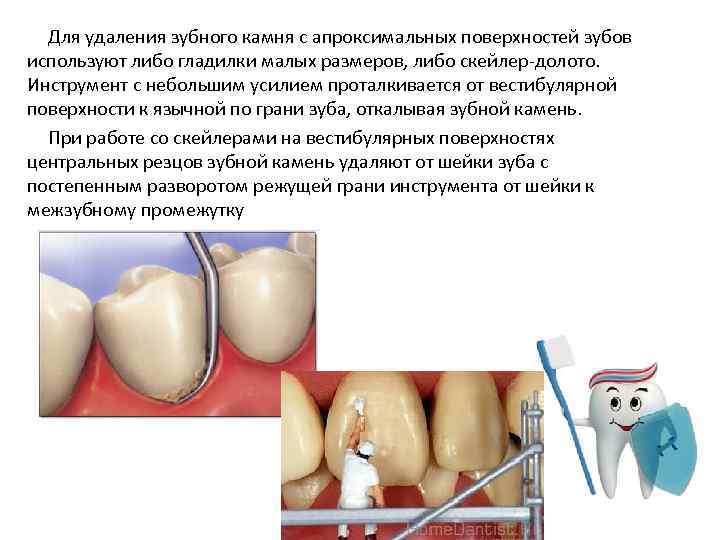 Для удаления зубного камня с апроксимальных поверхностей зубов используют либо гладилки малых размеров, либо