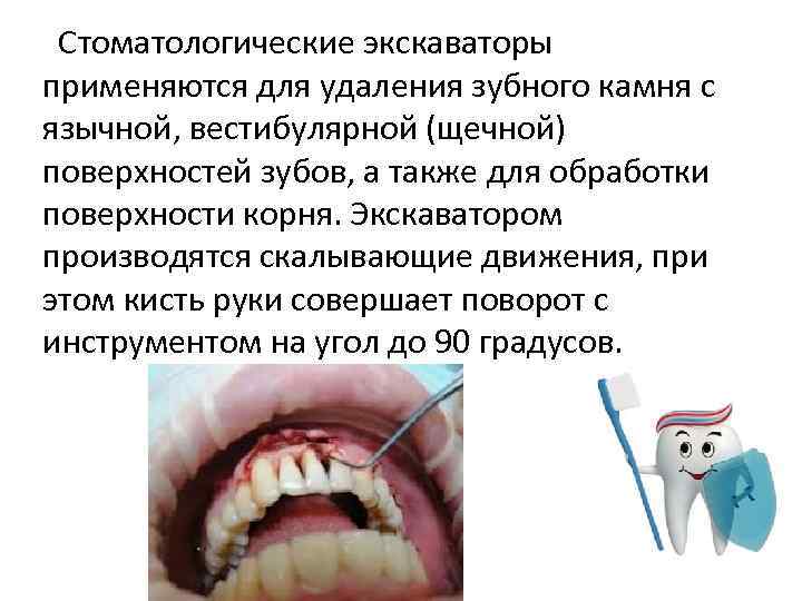 Стоматологические экскаваторы применяются для удаления зубного камня с язычной, вестибулярной (щечной) поверхностей зубов, а