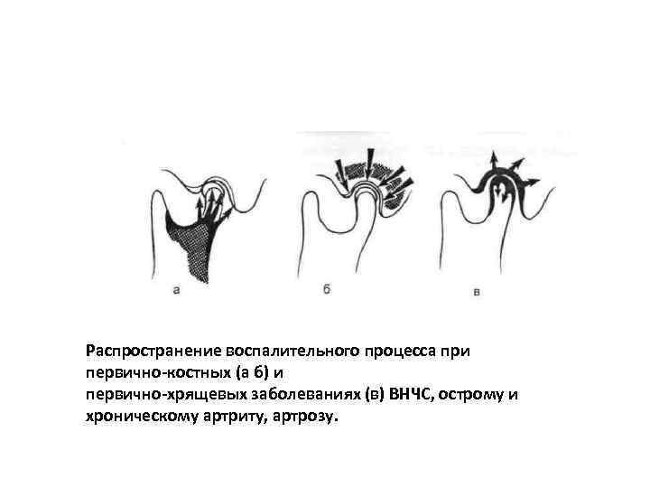 Распространение воспалительного процесса при первично-костных (а б) и первично-хрящевых заболеваниях (в) ВНЧС, острому и