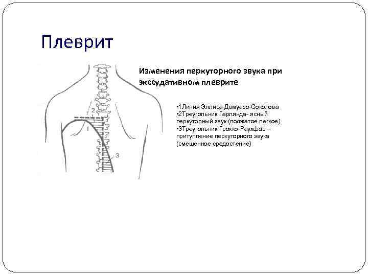 Перкуторная картина у больных с экссудативным плевритом