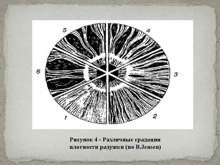 Рисунок 4 - Различные градации плотности радужки (по B. Jensen) 