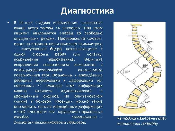 Угол кобба. Измерение угла сколиоза по чаклину. Степени сколиоза позвоночника по коббу. Метод Кобба сколиоз позвоночника. Угол Кобба степени сколиоза.