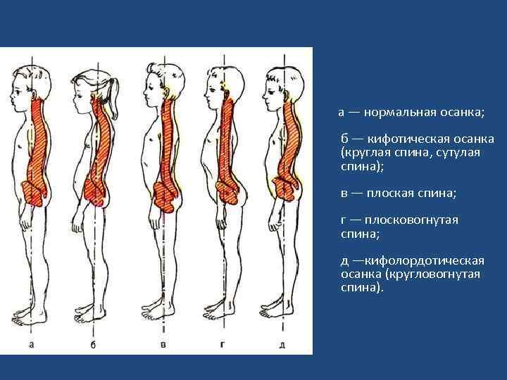 Как называется нарушение осанки изображенное на рисунке 3