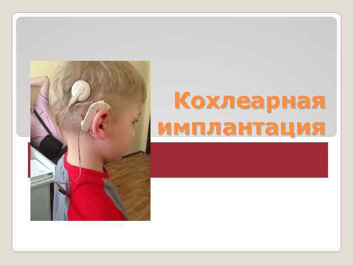 Кохлеарная имплантация 