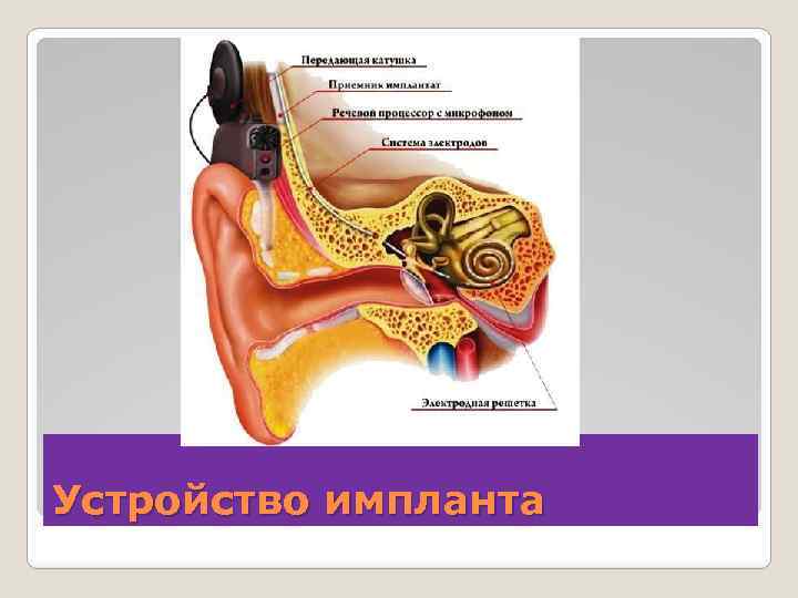 Устройство импланта 