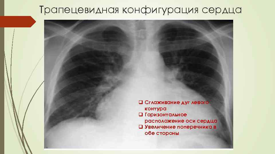 Трапецевидная конфигурация сердца q Сглаживание дуг левого контура q Горизонтальное расположение оси сердца q