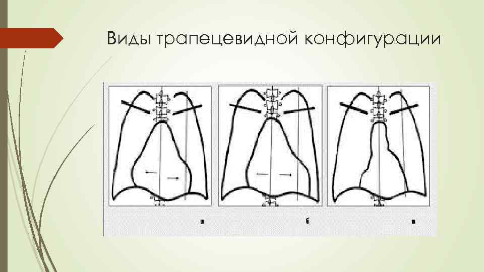 Виды трапецевидной конфигурации 