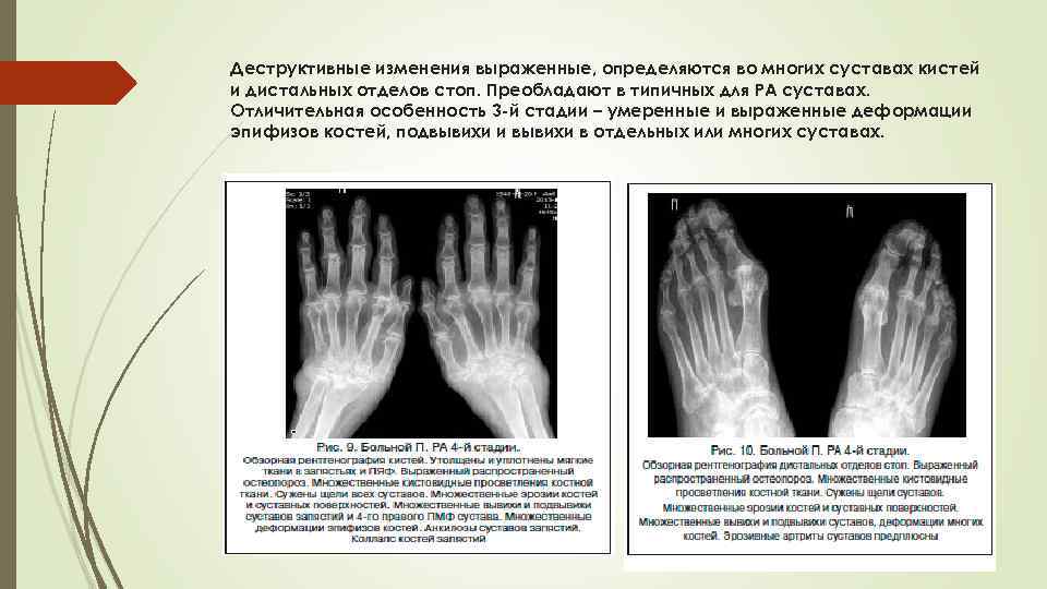 Деструктивные изменения выраженные, определяются во многих суставах кистей и дистальных отделов стоп. Преобладают в