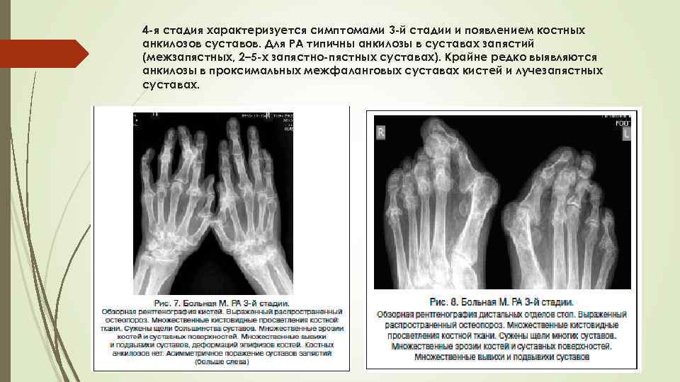 4 -я стадия характеризуется симптомами 3 -й стадии и появлением костных анкилозов суставов. Для