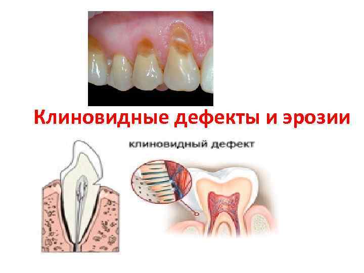 Клиновидные дефекты и эрозии 