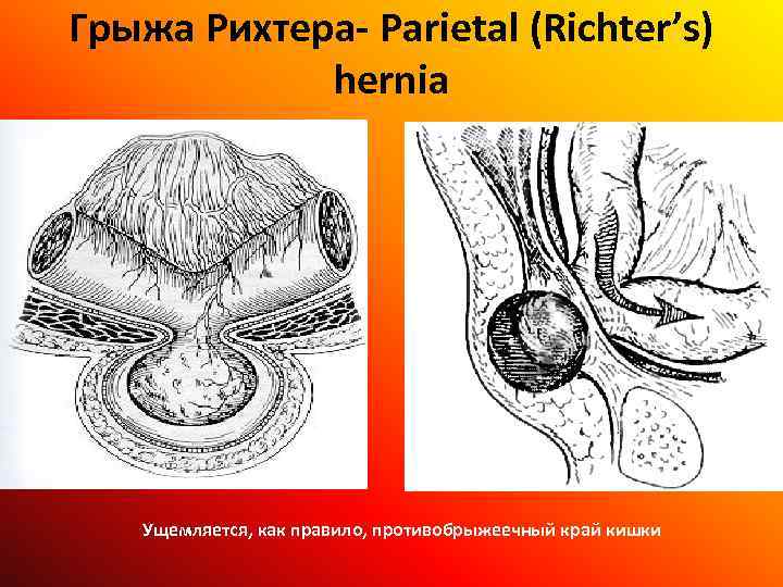 Грыжа Рихтера- Parietal (Richter’s) hernia Ущемляется, как правило, противобрыжеечный край кишки 