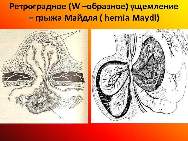 Ретроградное (W –образное) ущемление = грыжа Майдля ( hernia Maydl) 