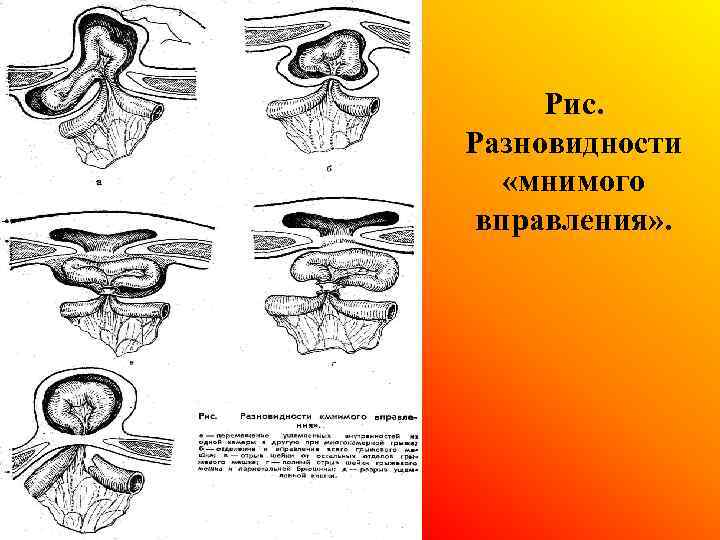 Рис. Разновидности «мнимого вправления» . 