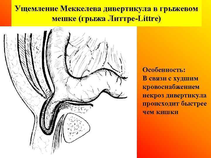 Ущемление Меккелева дивертикула в грыжевом мешке (грыжа Литтре Littre) Особенность: В связи с худшим