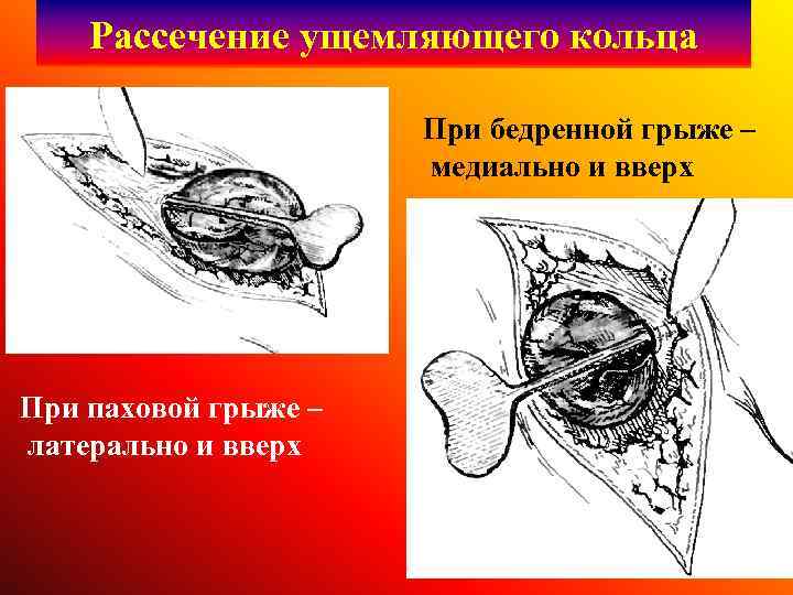 Рассечение ущемляющего кольца При бедренной грыже – медиально и вверх При паховой грыже –