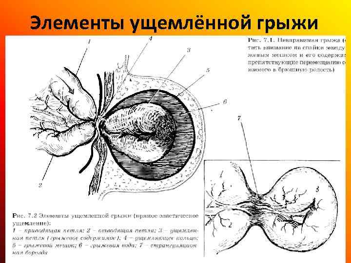 Элементы ущемлённой грыжи 