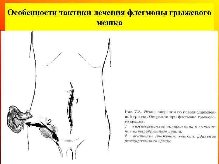 Особенности тактики лечения флегмоны грыжевого мешка 