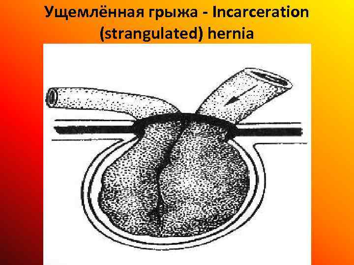 Ущемлённая грыжа - Incarceration (strangulated) hernia 