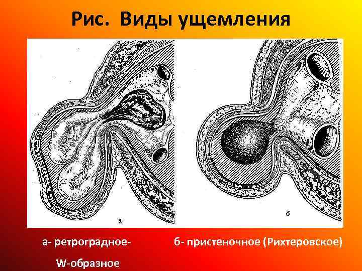 Рис. Виды ущемления а- ретроградное- б- пристеночное (Рихтеровское) W-образное 