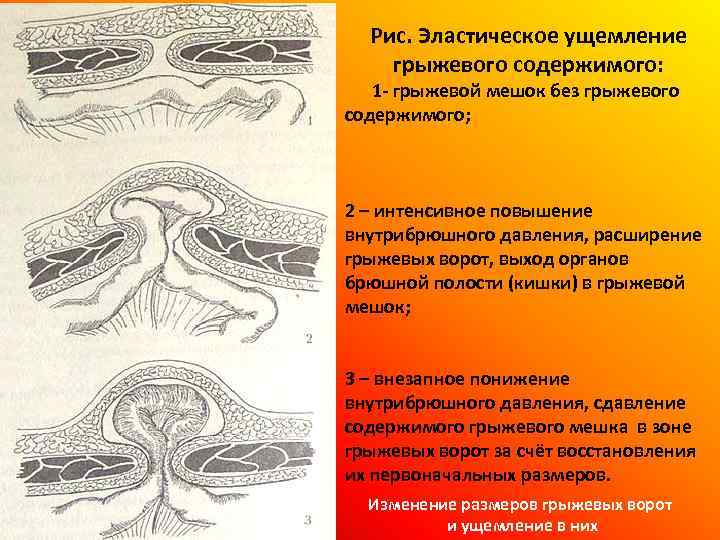 Рис. Эластическое ущемление грыжевого содержимого: 1 - грыжевой мешок без грыжевого содержимого; 2 –