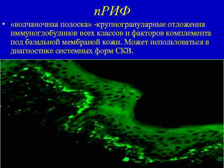 п. РИФ • «волчаночная полоска» -крупногранулярные отложения иммуноглобулинов всех классов и факторов комплемента под