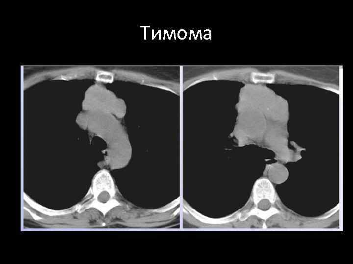 Тимома кт картина
