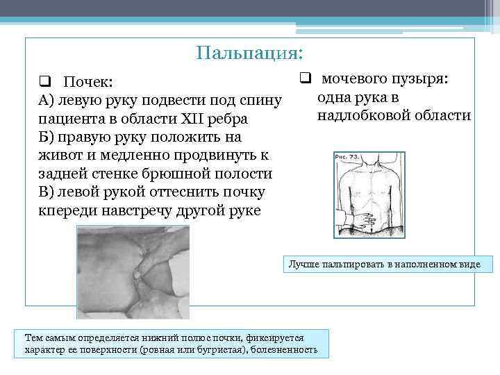 Пальпация: q Почек: А) левую руку подвести под спину пациента в области XII ребра