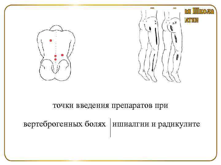 точки введения препаратов при вертеброгенных болях ишиалгии и радикулите 