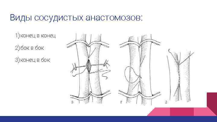 Кафедра топографической анатомии. Типы анастомозов сосудов. Сосудистый анастомоз конец в конец. Конец в конец бок в бок виды анастомозов. Сосудистый анастомоз бок в бок.