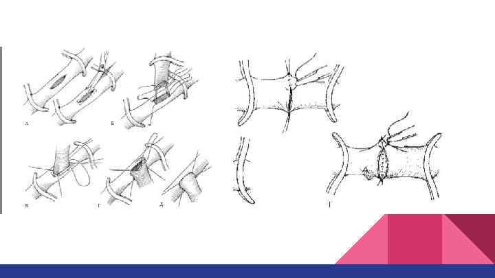 Сосудистый шов топографическая анатомия презентация
