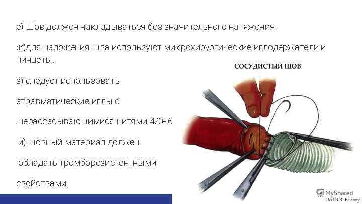 е) Шов должен накладываться без значительного натяжения ж)для наложения шва используют микрохирургические иглодержатели и
