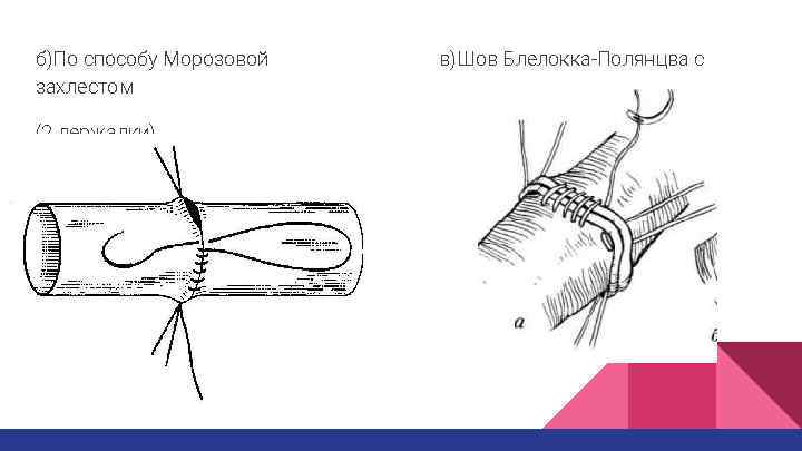 б)По способу Морозовой захлестом (2 держалки) в)Шов Блелокка-Полянцва с 