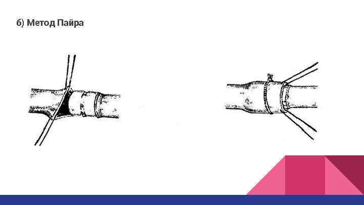 б) Метод Пайра 