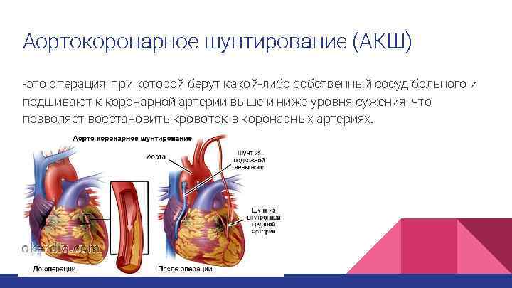 Аортокоронарное шунтирование (АКШ) -это операция, при которой берут какой-либо собственный сосуд больного и подшивают