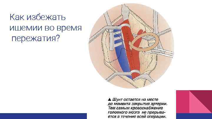 Как избежать ишемии во время пережатия? 