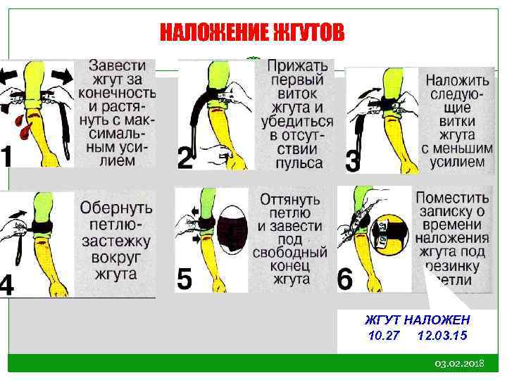 НАЛОЖЕНИЕ ЖГУТОВ ШАГ 1 ШАГ 4 ШАГ 2 ШАГ 3 ШАГ 5 ШАГ 6