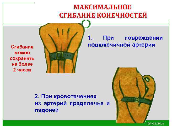 МАКСИМАЛЬНОЕ СГИБАНИЕ КОНЕЧНОСТЕЙ Сгибание можно сохранять не более 2 часов 1. При повреждении подключичной