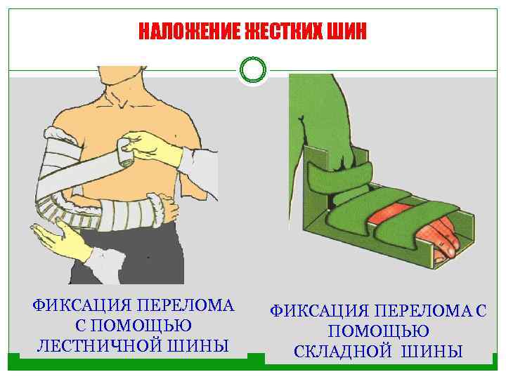 НАЛОЖЕНИЕ ЖЕСТКИХ ШИН ФИКСАЦИЯ ПЕРЕЛОМА С ПОМОЩЬЮ ЛЕСТНИЧНОЙ ШИНЫ ФИКСАЦИЯ ПЕРЕЛОМА С ПОМОЩЬЮ СКЛАДНОЙ