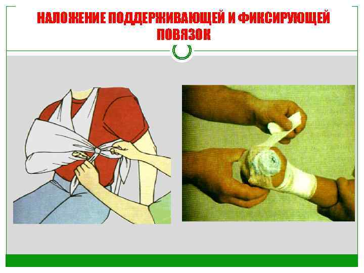 НАЛОЖЕНИЕ ПОДДЕРЖИВАЮЩЕЙ И ФИКСИРУЮЩЕЙ ПОВЯЗОК 