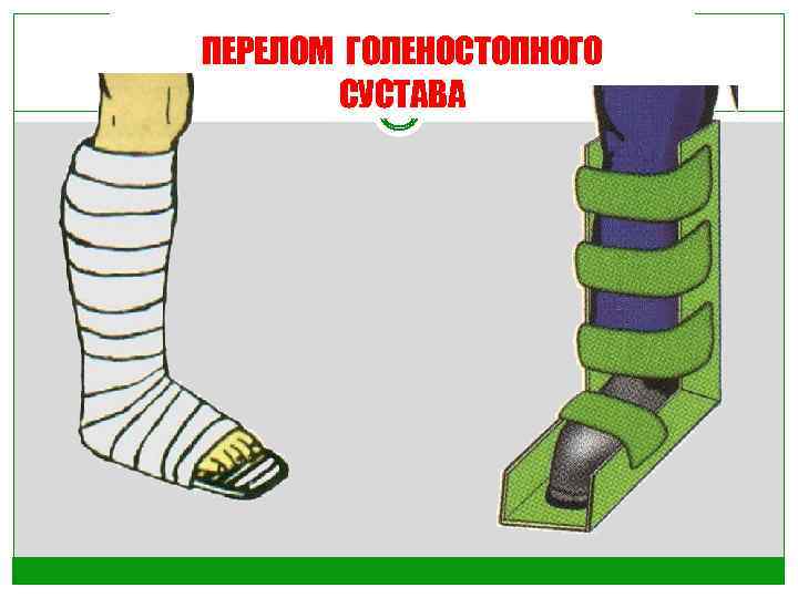 ПЕРЕЛОМ ГОЛЕНОСТОПНОГО СУСТАВА 