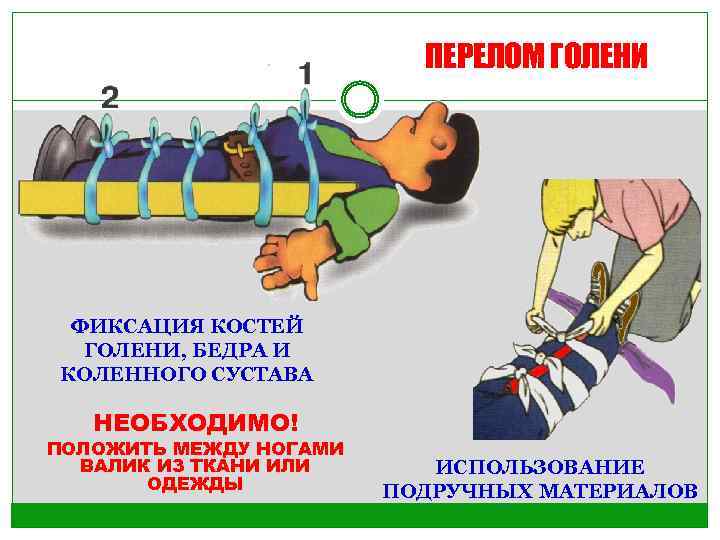 ПЕРЕЛОМ ГОЛЕНИ ФИКСАЦИЯ КОСТЕЙ ГОЛЕНИ, БЕДРА И КОЛЕННОГО СУСТАВА НЕОБХОДИМО! ПОЛОЖИТЬ МЕЖДУ НОГАМИ ВАЛИК